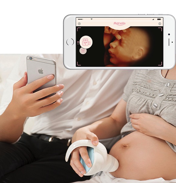 Marvoto一款可让孕妇随时为肚里宝宝拍照的产品创意设计